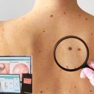 Mole Mapping Capstone Medical Southbank