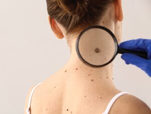 Skin Cancer And Mole Mapping Clinic in Southbank