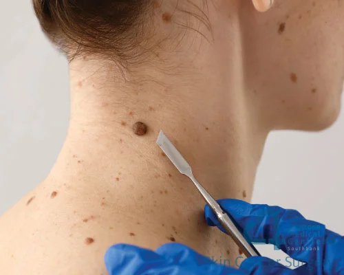 Skin-Cancer-Surgery-Clinic-Southbank-min - Capstone Medical Centre Southbank