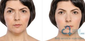 Anti-wrinkle injections Capstone