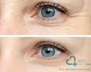 Anti-wrinkle injections