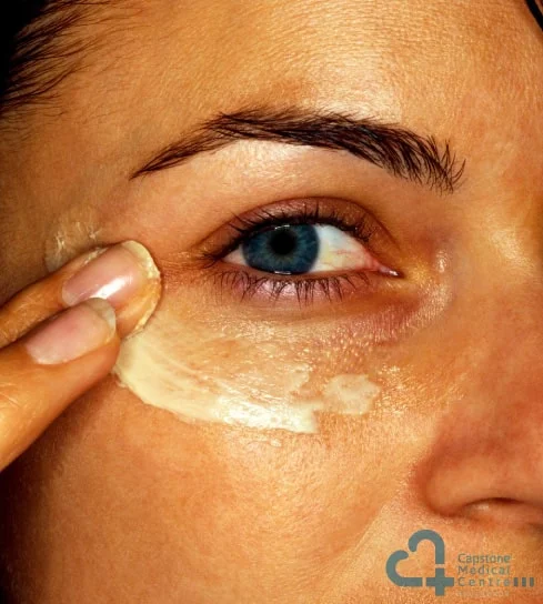 What causes dark circles under your eyes ?
