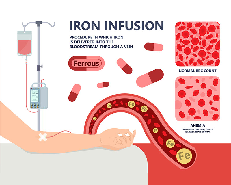 Iron infusion procedure