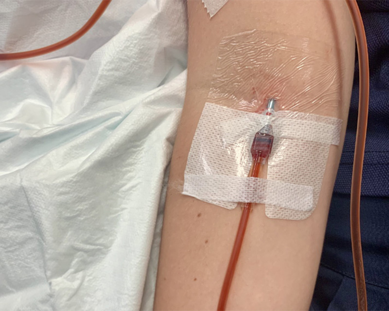Safety and Side Effects of Iron Infusion