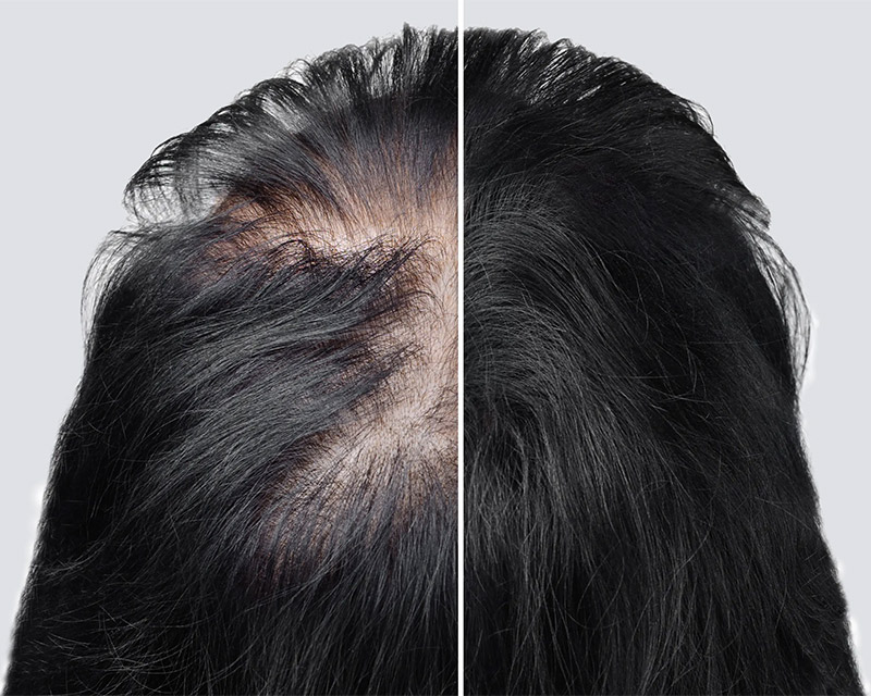 Types of Weight Loss-Related Hair Loss