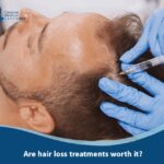 Are hair loss treatments worth it