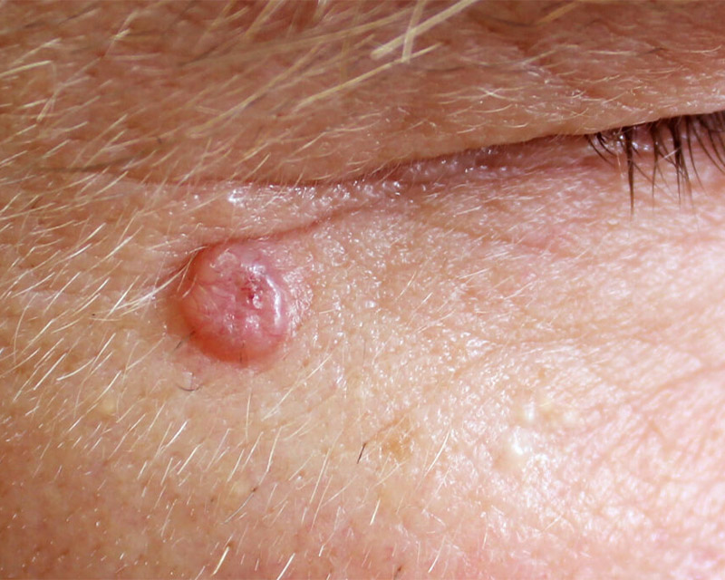 Basal Cell Carcinoma (BCC)