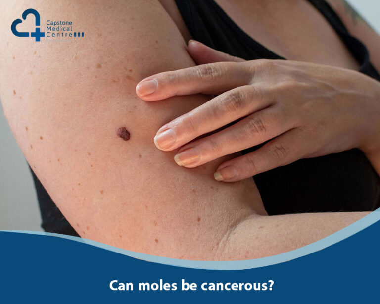 Can moles be cancerous