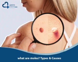 what are moles?