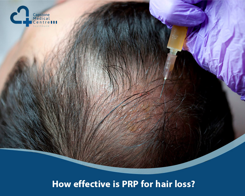 How effective is PRP for hair loss