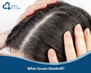What Causes Dandruff