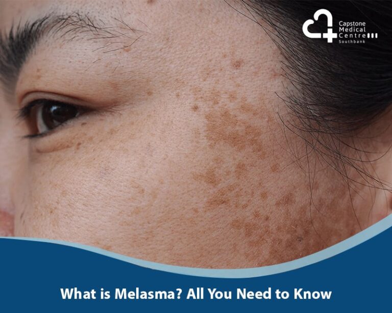 What is Melasma? All You Need to Know