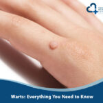Warts: Everything You Need to Know