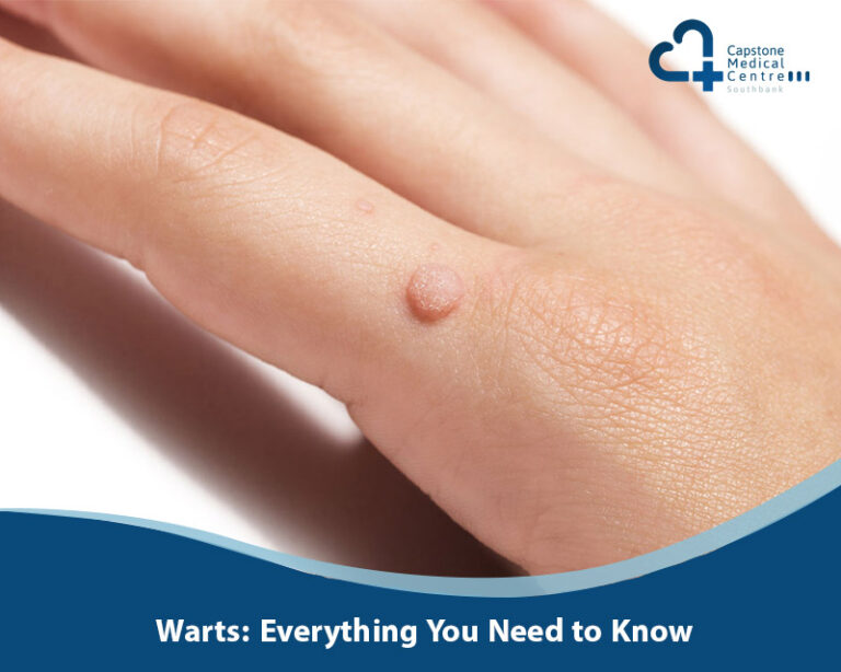Warts: Everything You Need to Know