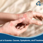 What is Eczema: Causes, Symptoms, and Treatments