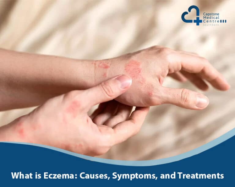 What is Eczema: Causes, Symptoms, and Treatments