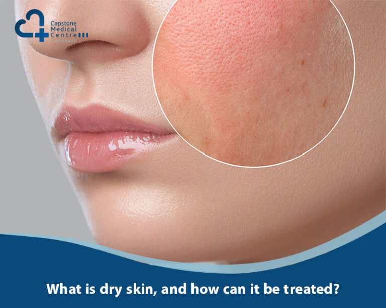 What is dry skin, and how can it be treated