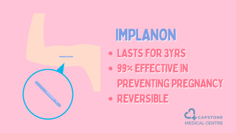What Is A Contraceptive Implant Capstone Medical Centre Southbank