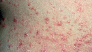 Psoriasis