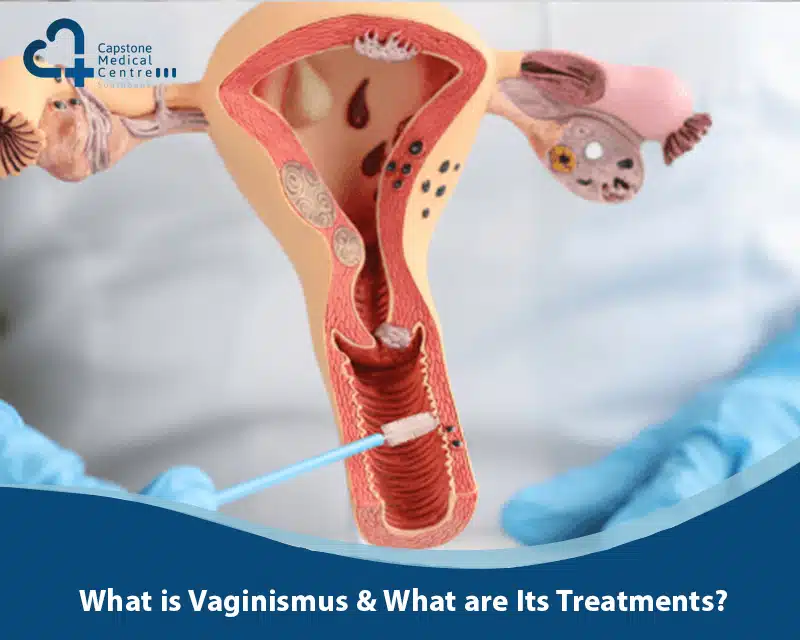 Vaginismus